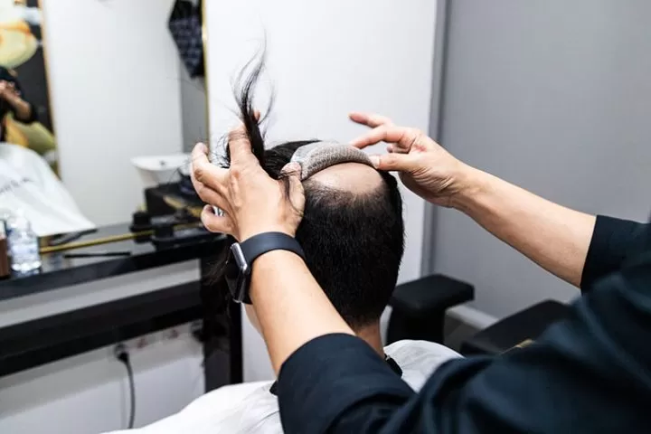 5 Best Hair Replacement & Hair Transplant Salons in Singapore