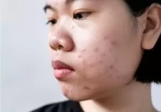 young-asian-female-experiencing-facial-acne