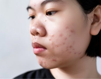 young-asian-female-experiencing-facial-acne